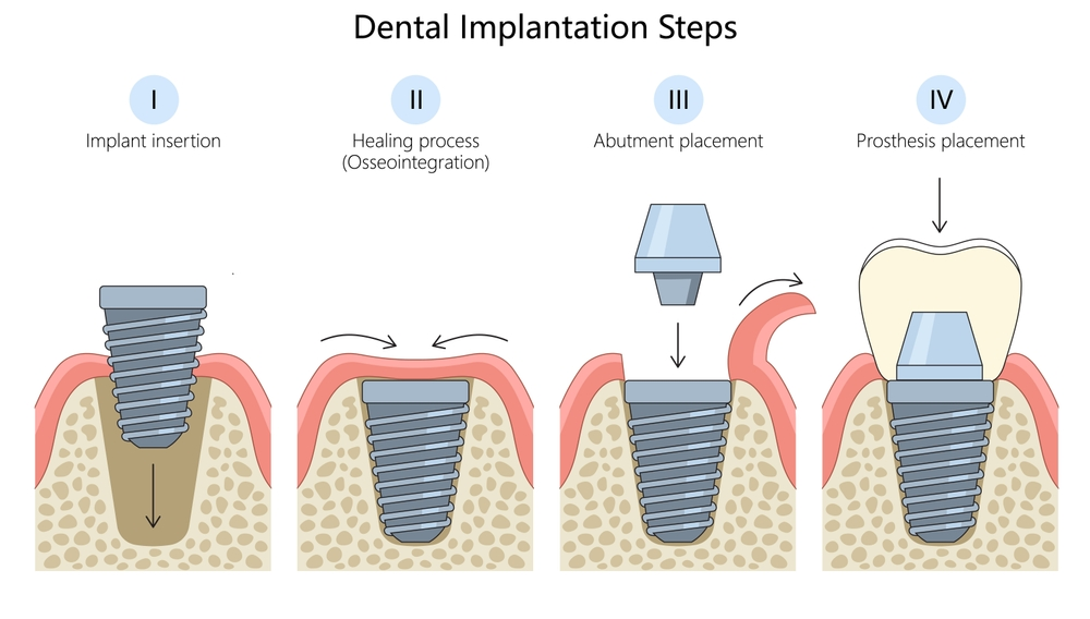 If you’re dealing with a cavity or broken tooth, our doctor of dental surgery can evaluate your dental history and determine if a bone graft is necessary before placing the implant into your jaw, ensuring effective results and long-term stability.