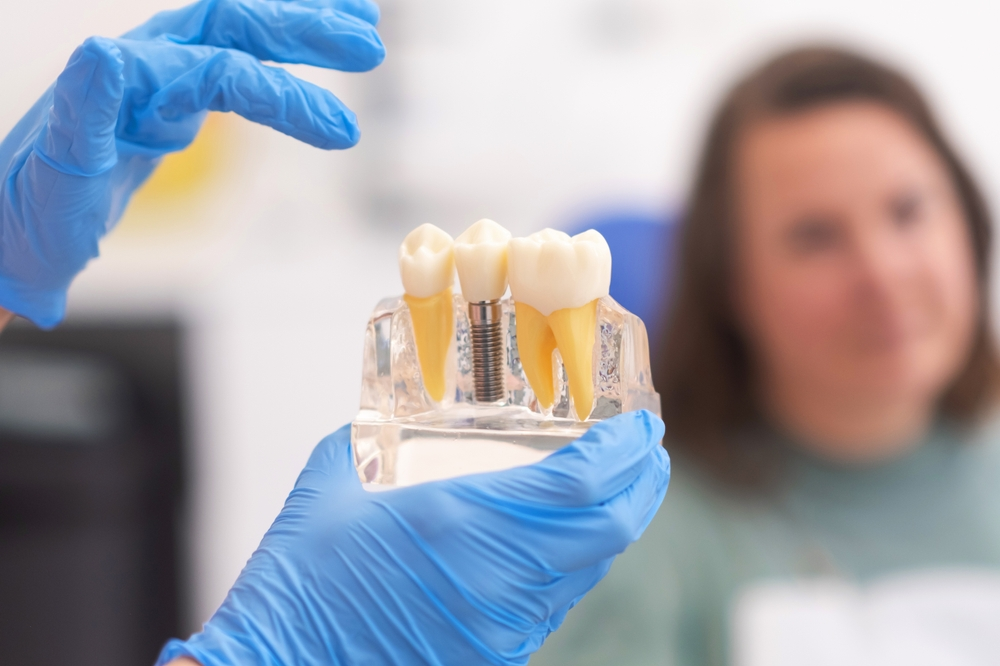 Implant-supported dentures are an excellent alternative to full dentures, providing a secure fit by connecting to a dental implant post, which is surgically placed at the top of the implant for enhanced functionality and comfort.