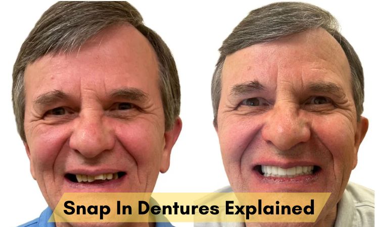Snap In Dentures