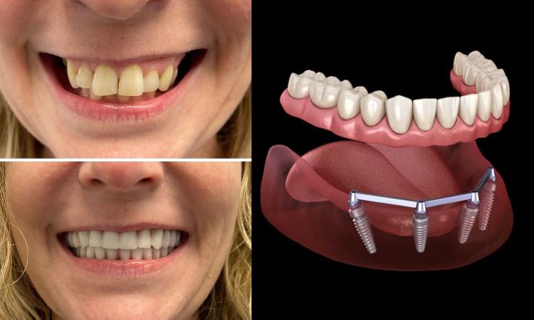Snap in Dentures Snap in Dentures