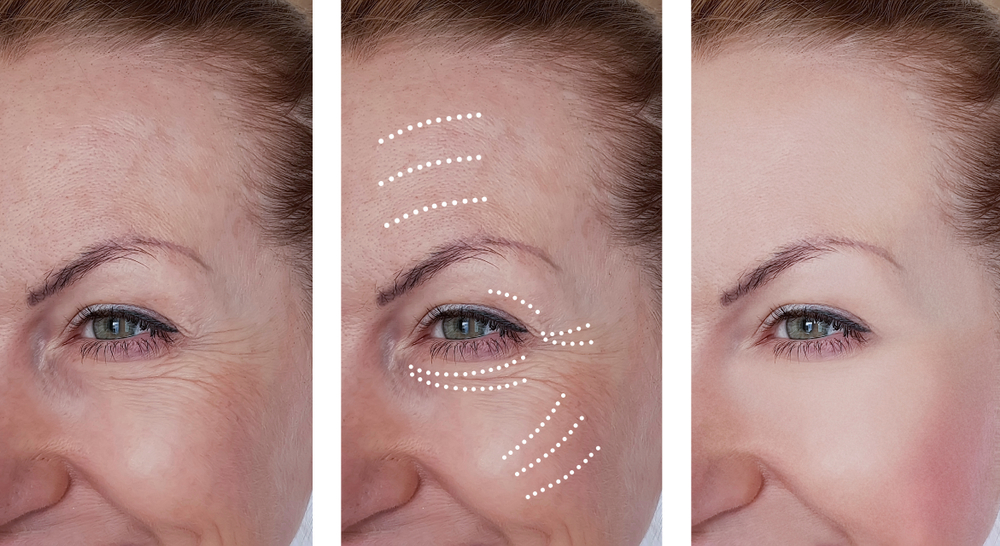 Botox in Arlington VA Botox in Arlington VA