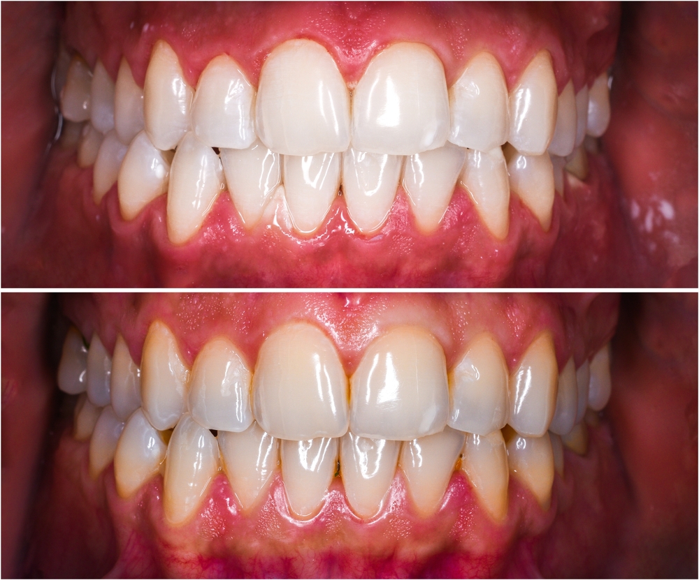 Teeth Whitening in Arlington Teeth Whitening in Arlington
