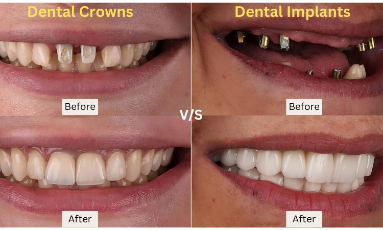 dental crowns in arlington