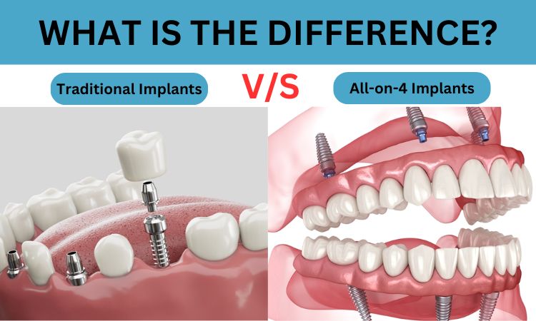 Comparison chart of traditional dental implants vs All-on-4 treatment for full-arch tooth replacement solutions.
