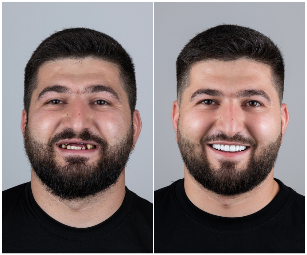Benefits of Dental Crowns If you're considering dental implants or want a straighter smile, dental crowns are a key part of the restoration process.