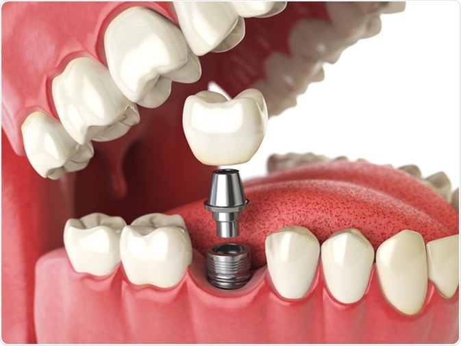 Dental implant tooth replacement