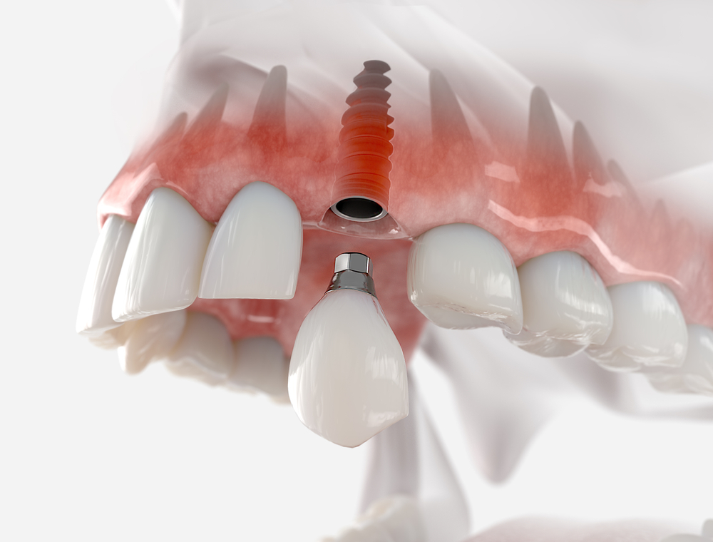 Standard implant placement often involves Bone regeneration, while All-on-4 implants require fewer surgical procedures