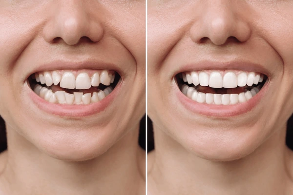 Cosmetic dentistry results in Arlington VA