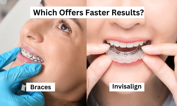dental veneers in Arlington