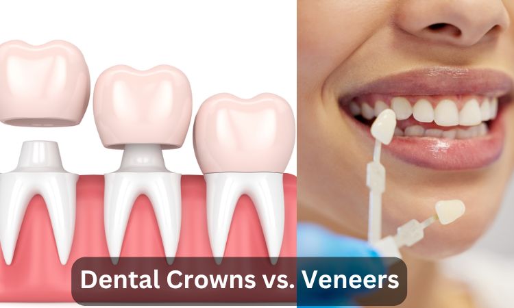 Dental Crowns vs. Veneers