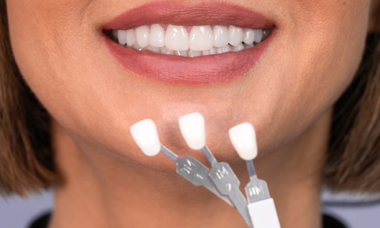 Dental Veneers Are the Top Choice for Arlington Residents