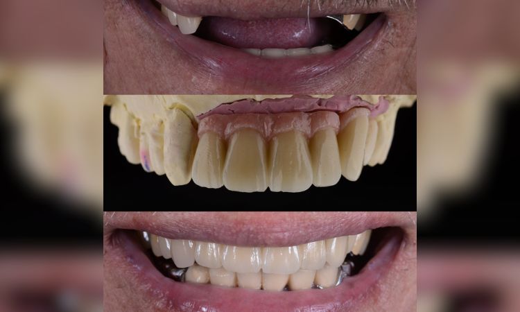 Implant-supported dentures- before after