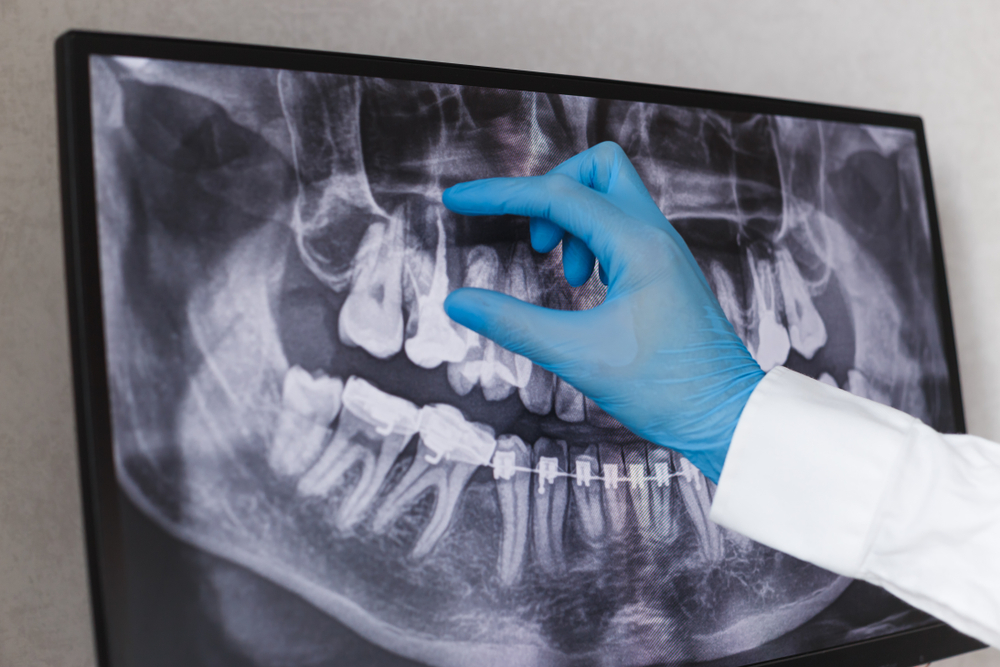Benefits of Choosing a Cosmetic Dentist for a Root Canal