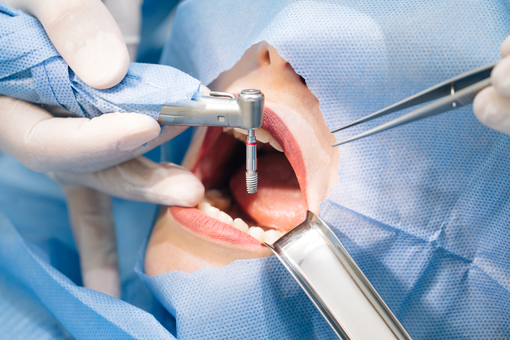 The Dental Implant Procedure