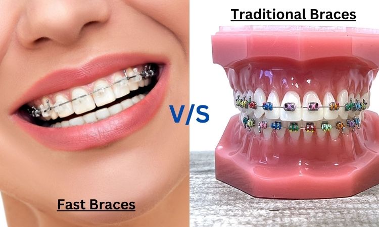 Fast Braces V/S Traditional Braces