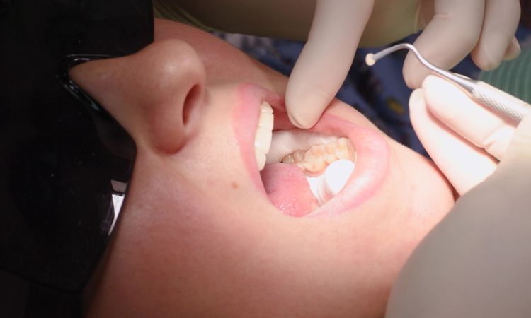 Allergic to Composite Fillings