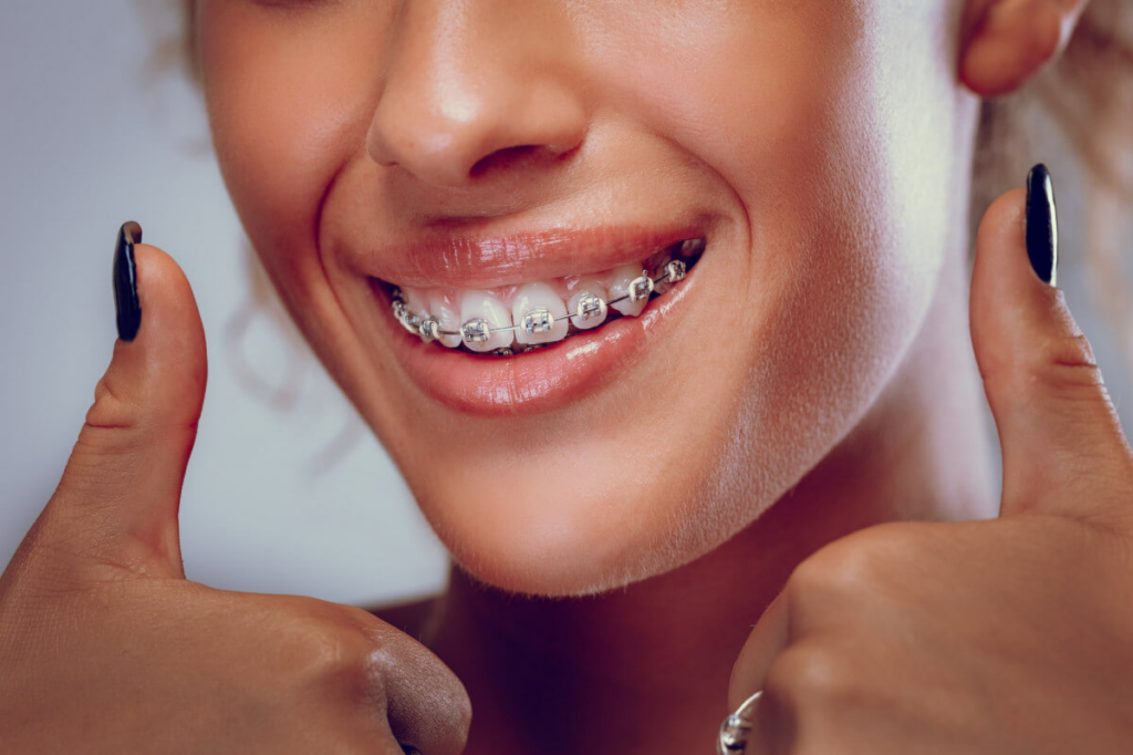 Difference between Fast Braces and Traditional Braces