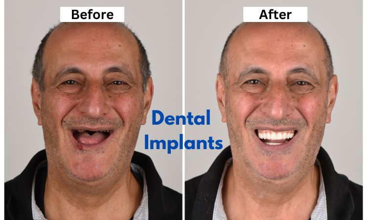 Before and After Dental Implants