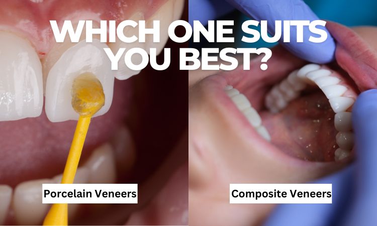 Porcelain vs. Composite Veneers in Arlington