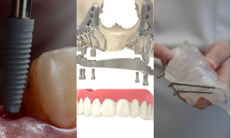 Three Types of Dental Implants