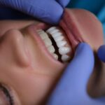 veneers in arlington