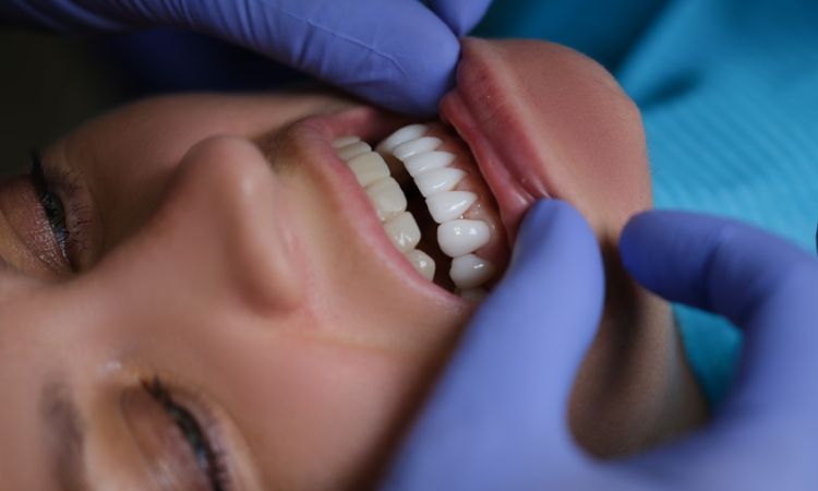 veneers in arlington