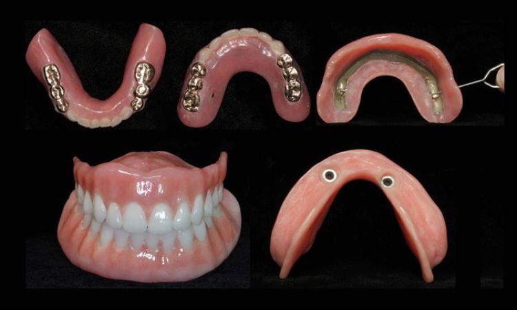 snap-in dentures