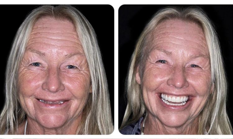 Care Tips to Prolong the Life of Snap-In Dentures