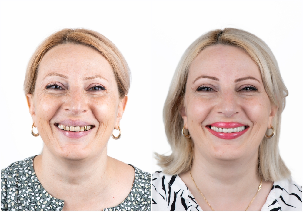 Are Full-Mouth Veneers Necessary