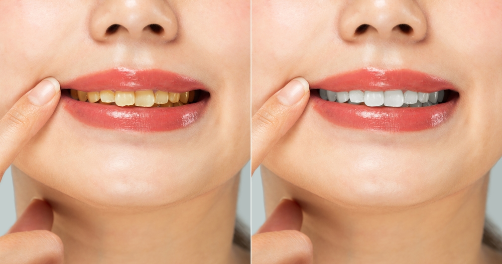 Good Candidate for Teeth Whitening