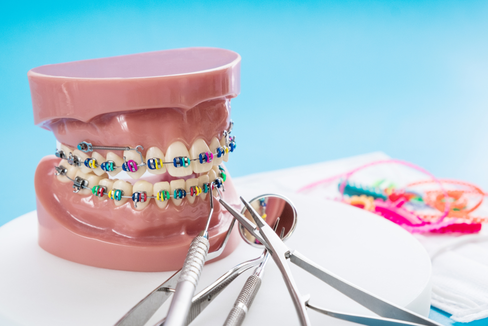 Alternatives to Invisible Braces