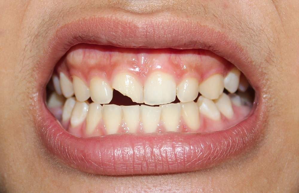 Chipped vs. Cracked Teeth