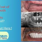 full mouth dental implants cost