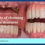 benefits of snap-in dentures
