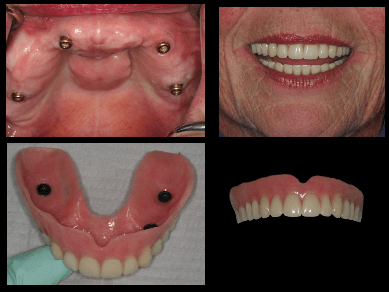 Schedule your personalized consultation for snap-in dentures at cosmo smiles dental