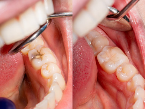 Factors That Influence Dental Sealant Pricing in Arlington