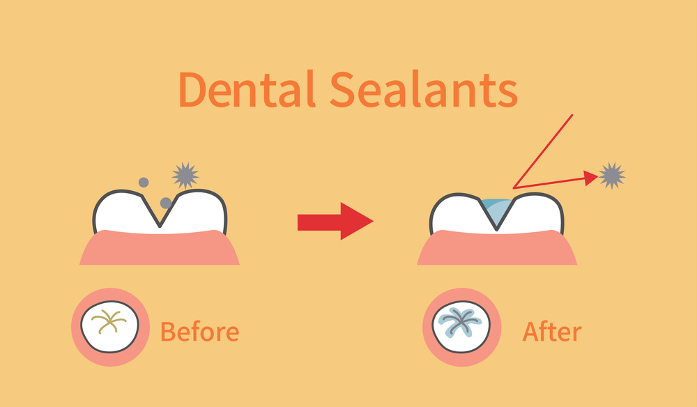 Benefits of Tooth Sealants: Before and after