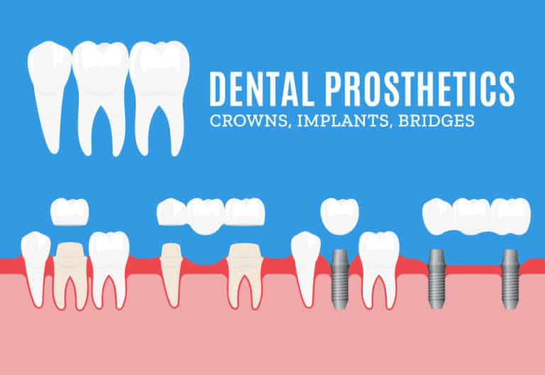 Alternatives to Dental Crowns for Cracked Teeth