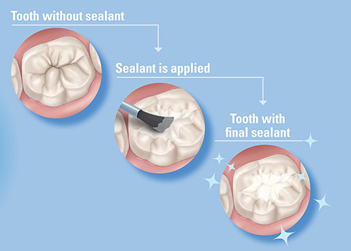 Tooth Sealants are highly recommended since younger teeth are more prone to cavities