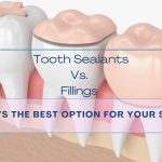 tooth sealants vs fillings arlington