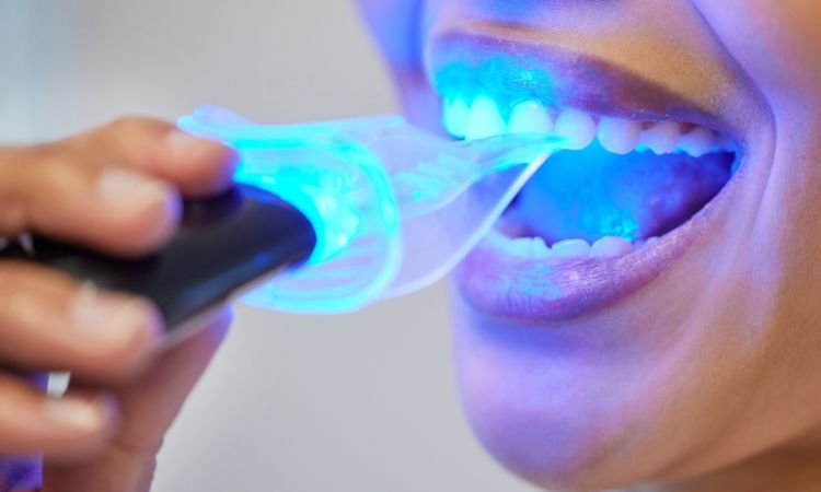 Benefits of Professional Teeth Whitening