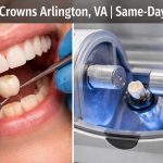 Dental Crowns Arlington VA