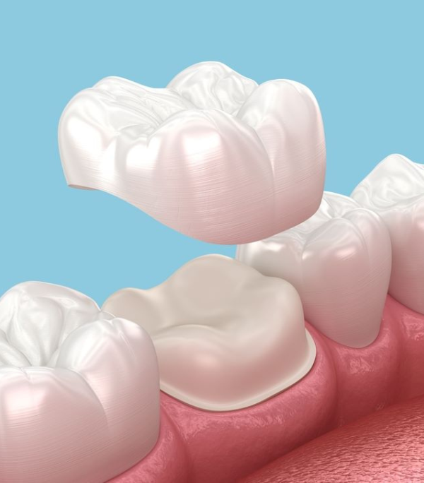 Dental Crowns 600X684
