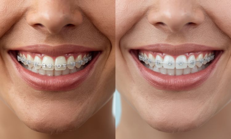 Invisalign vs Braces for Adults in Arlington