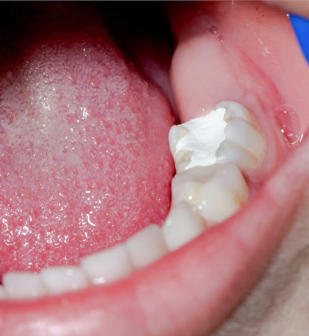 Tooth Fillings 628X684