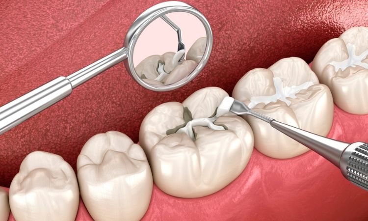 Tooth sealants at Cosmo Smiles Dental Arlington