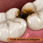 Tooth Sealants in Arlington