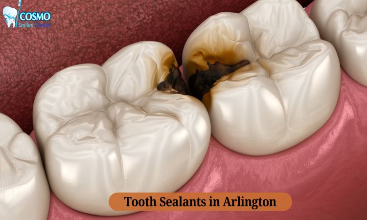 Tooth Sealants in Arlington