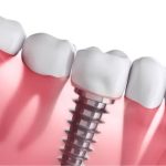 Dental Implants Arlington