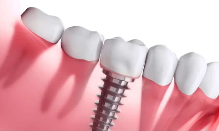 Dental Implants Arlington
